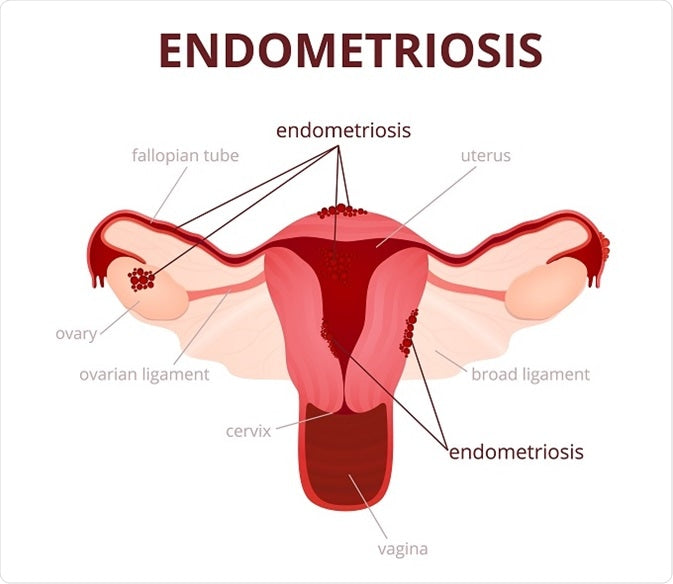 Endometriosis diagram